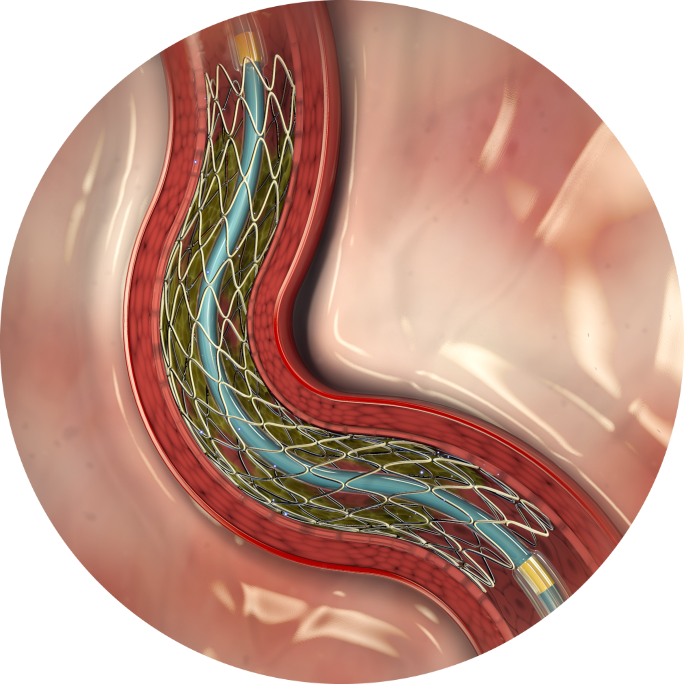 X0000_Medtronic_Resolute Integrity stent-fotor-2024032117112