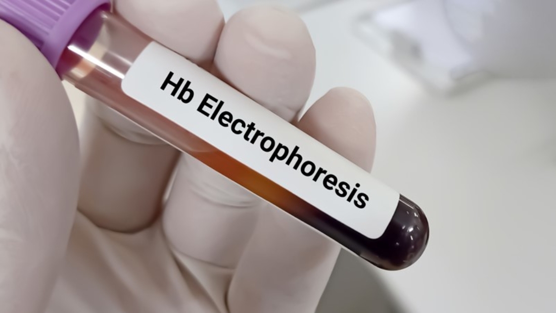 Hemoglobin Electrophoresis