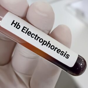 Hemoglobin Electrophoresis